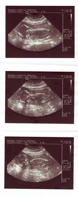 Ultrasound 20 weeks